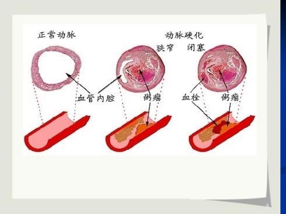 动脉硬化ppt课件_第5页