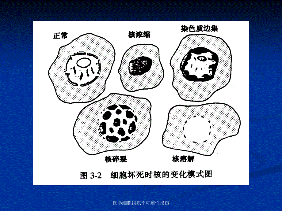 医学细胞组织不可逆性损伤课件_第4页