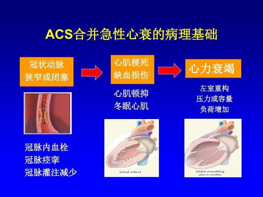 急性冠脉综合征合并心力衰竭_第5页