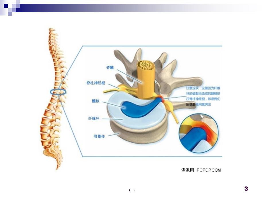 腰椎间盘突出的影像诊断ppt课件_第3页