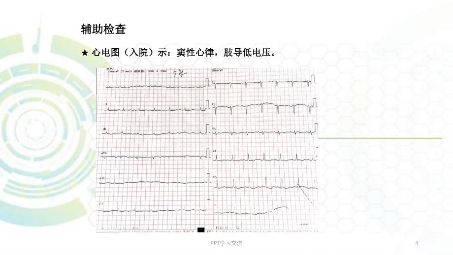 淀粉样变性心肌病课件_第4页