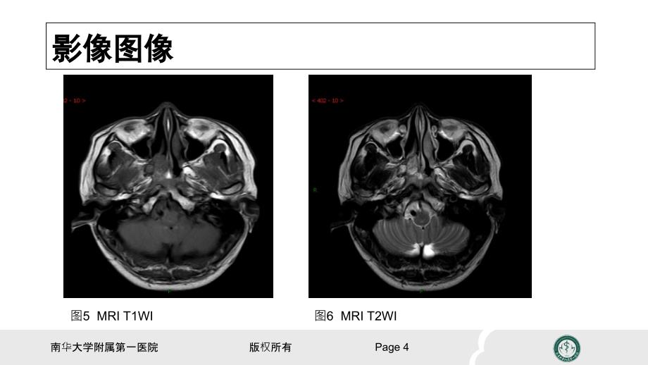 鼻咽纤维血管瘤的影像表现及临床_第4页