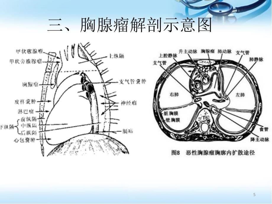 胸腺瘤影像表现ppt参考课件_第5页