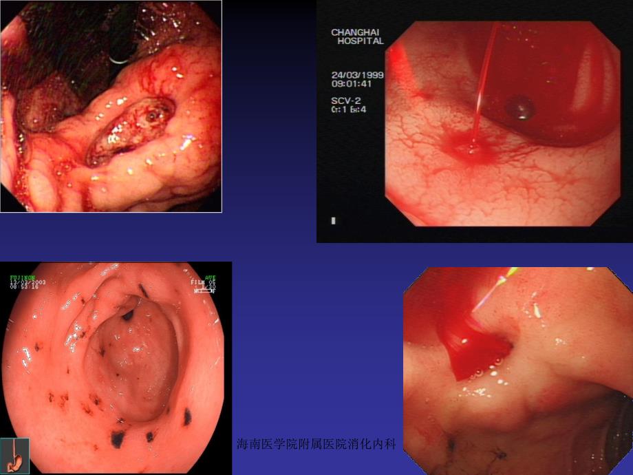 胃十二指肠出血课件_第2页