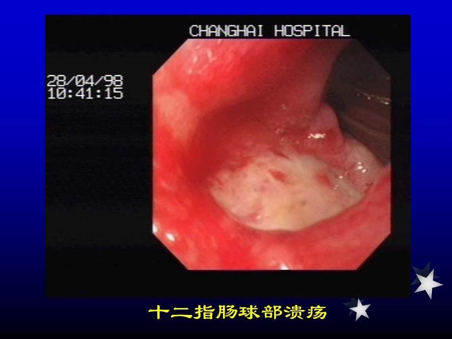 上消化道出血讲课课件_第5页