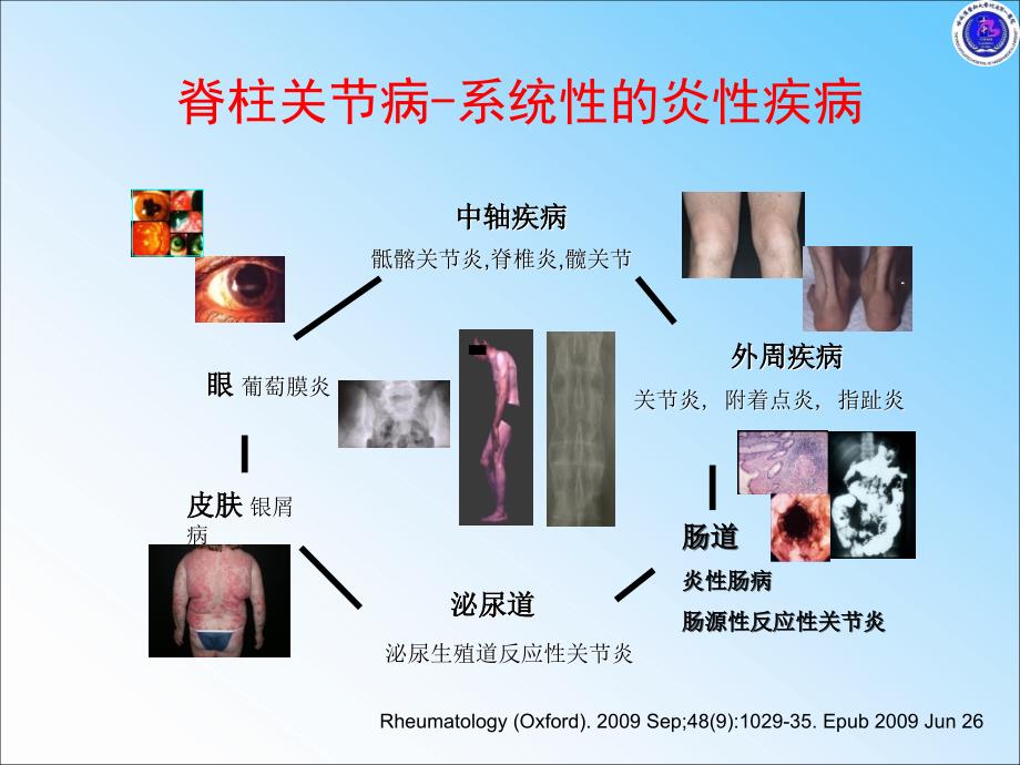 强直性脊柱炎不仅仅在脊柱课件_第3页