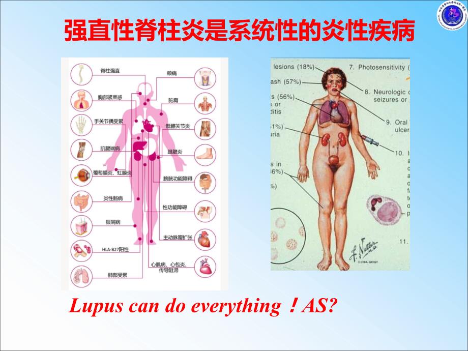 强直性脊柱炎不仅仅在脊柱课件_第4页