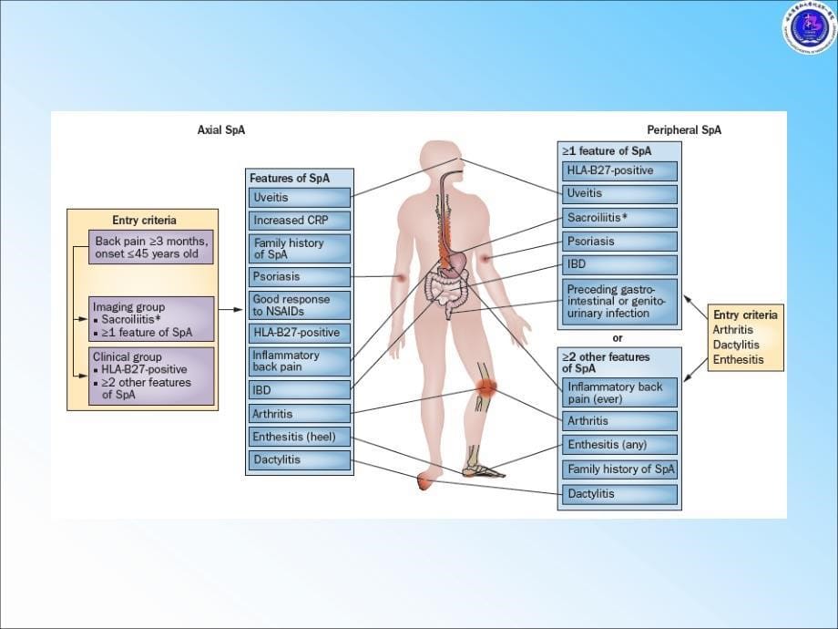 强直性脊柱炎不仅仅在脊柱课件_第5页