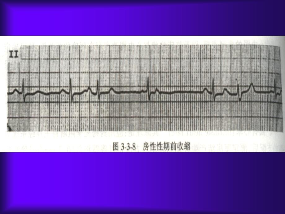 房性心律失常详解课件_第3页