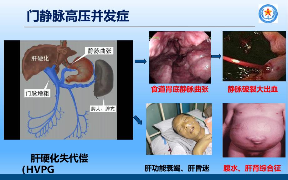 TIPS治疗肝硬化门脉高压讲课讲稿_第2页