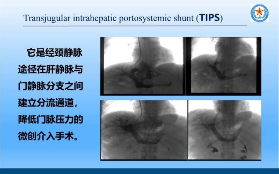 TIPS治疗肝硬化门脉高压讲课讲稿_第4页