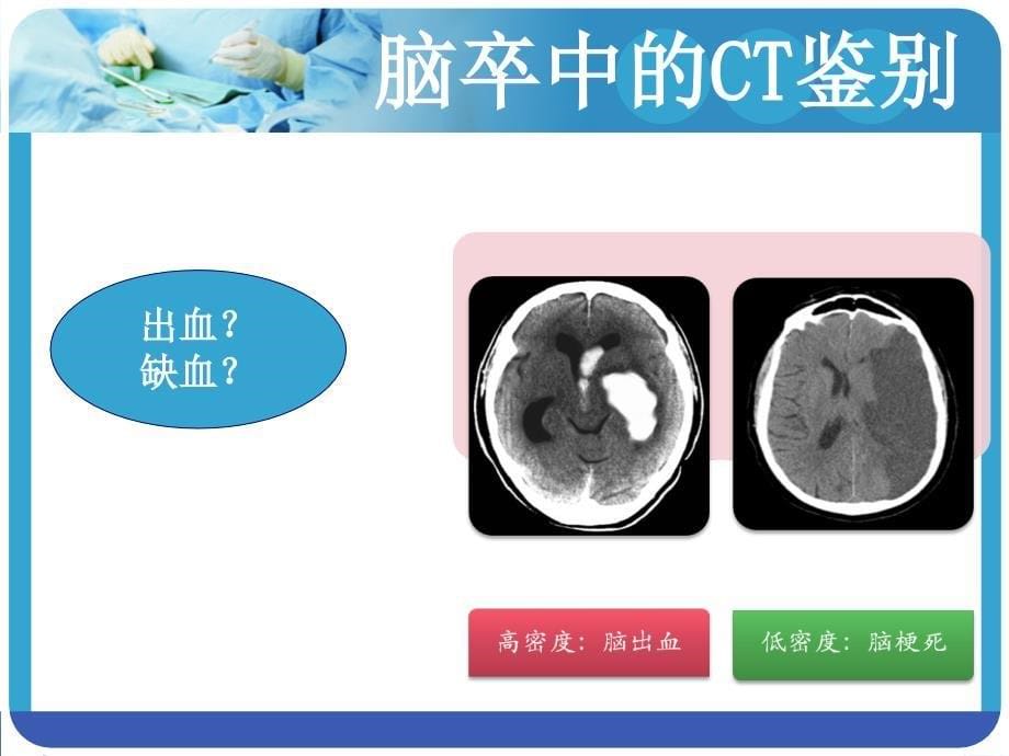 脑卒中溶栓患者的病例讨论_第5页