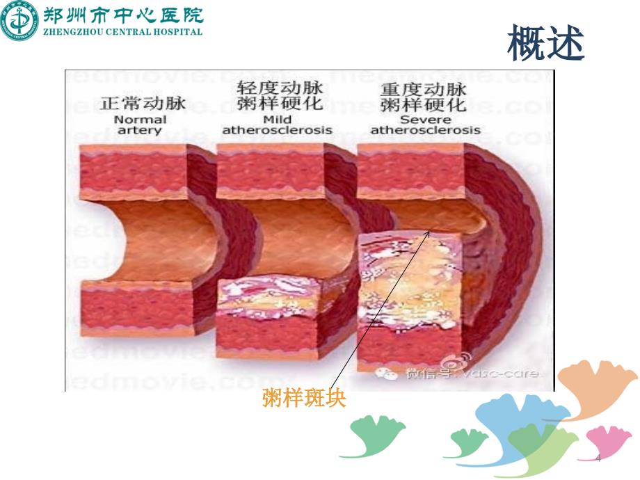 冠心病的常规护理PPT课件_第4页