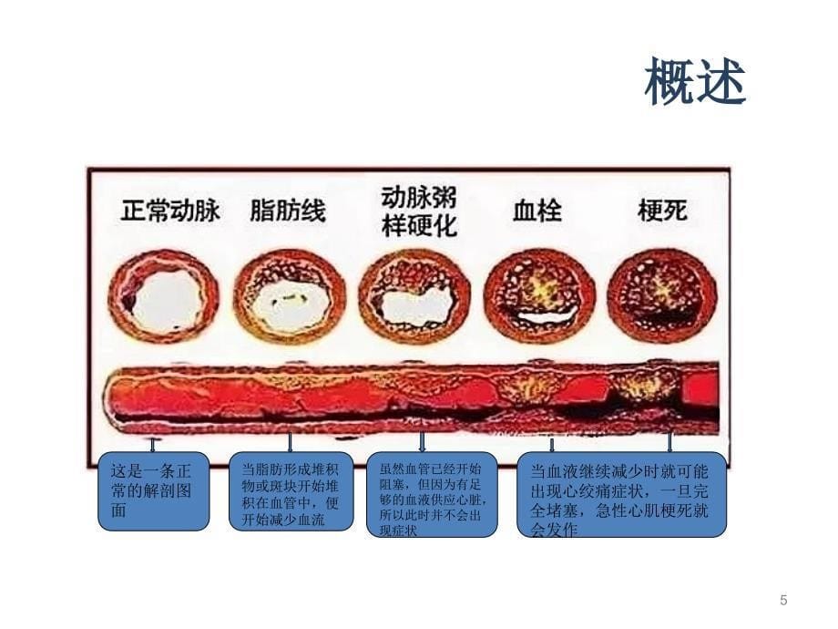 冠心病的常规护理PPT课件_第5页