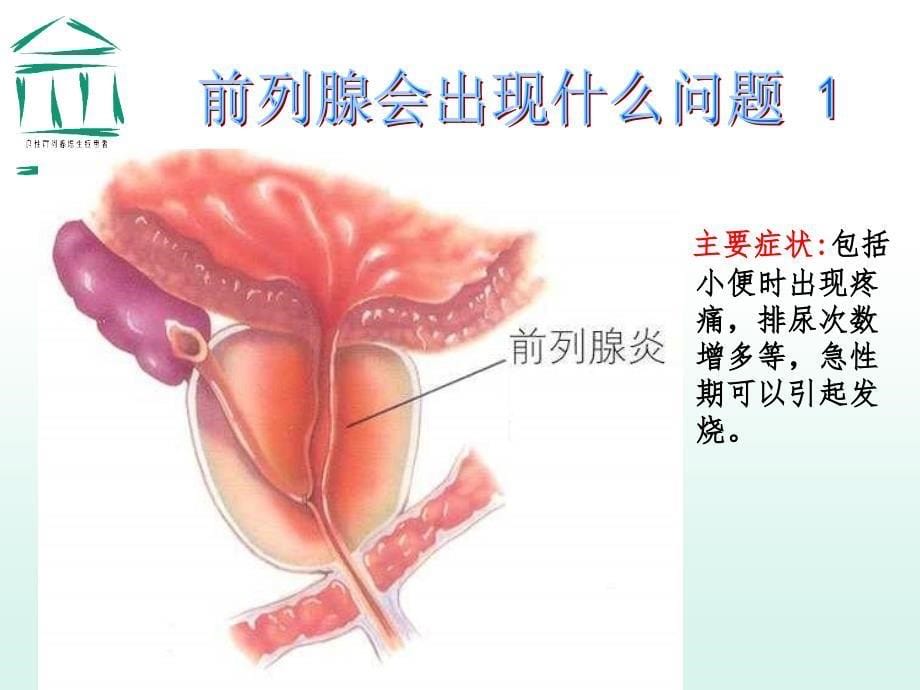 前列腺增生症健康教育讲座taoweiqi_第5页