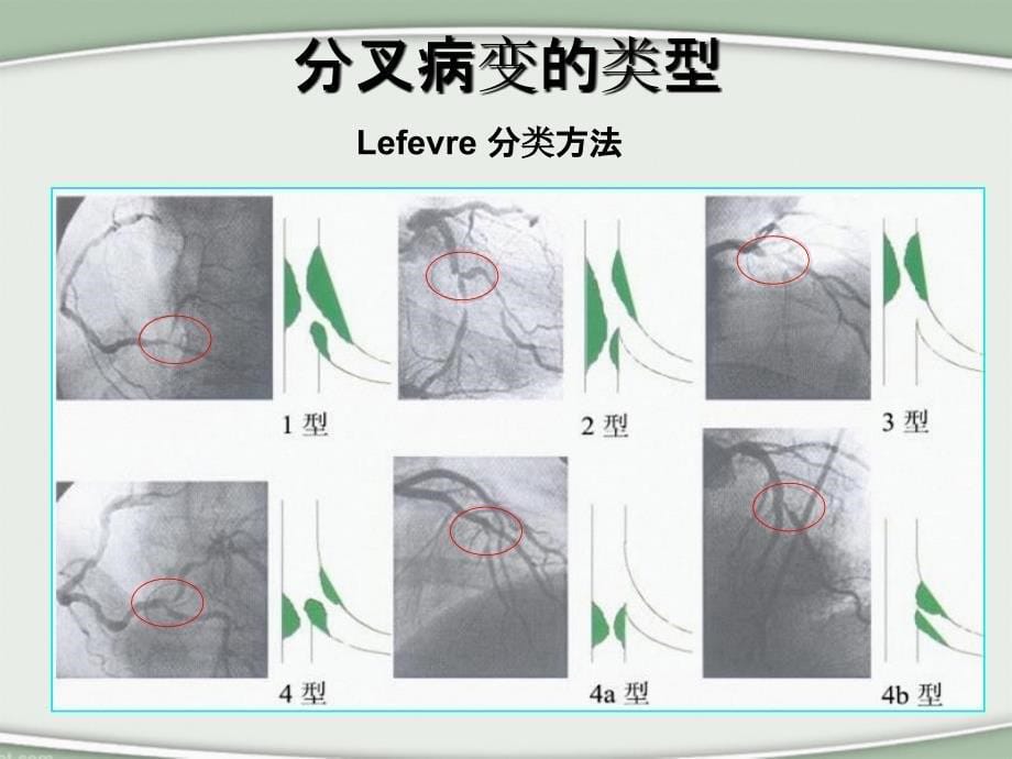 分叉病变的介入治疗术式选择PCIofBifurcationLesions教学课件_第5页