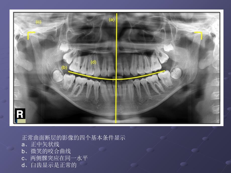 全景曲面断层中经常出现的错误图像原因_第2页