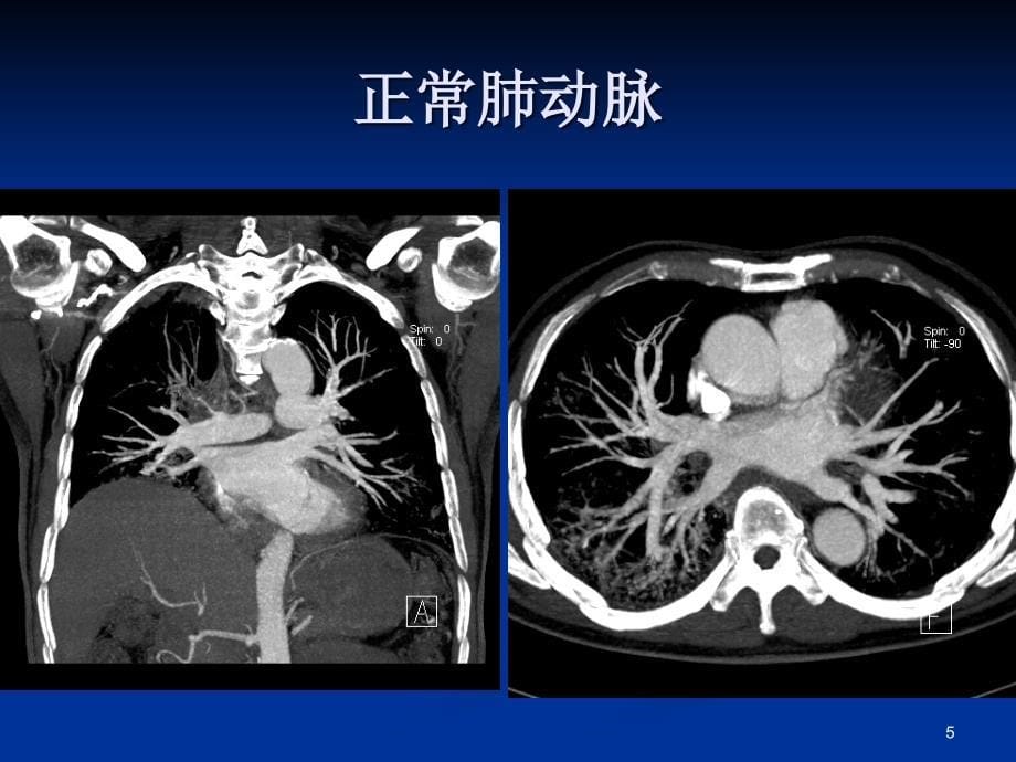 推荐精选胸痛三联征影像诊断_第5页