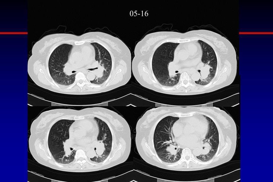 肺结节病病例分享ppt课件_第5页