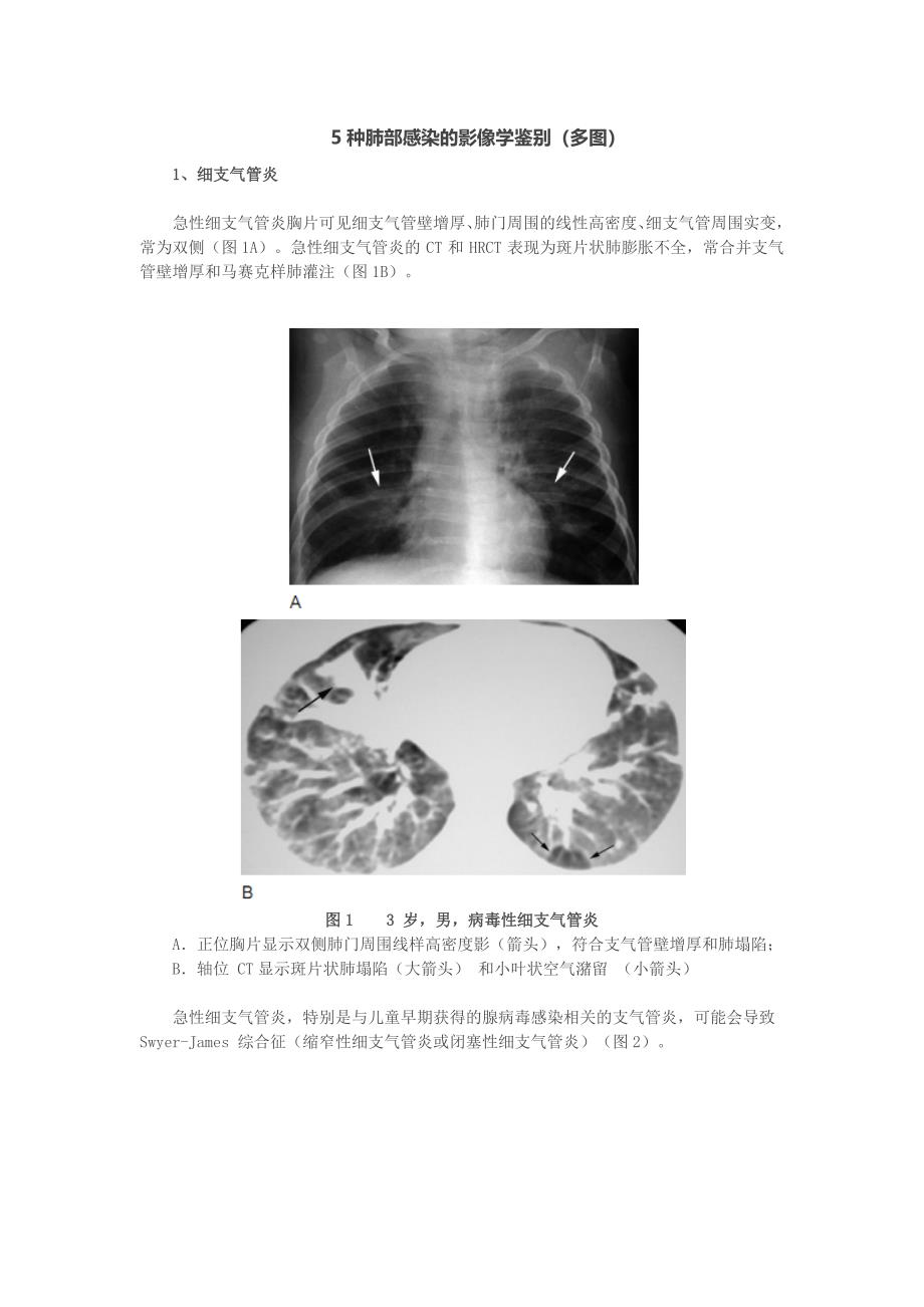 5种肺部感染的影像学鉴别(多图)_第1页