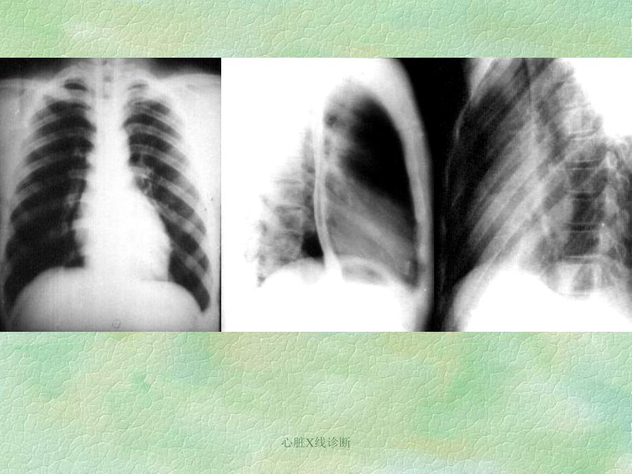 心脏X线诊断课件_第4页