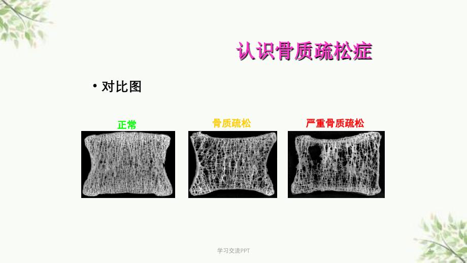 骨质疏松症概论医学课件_第4页