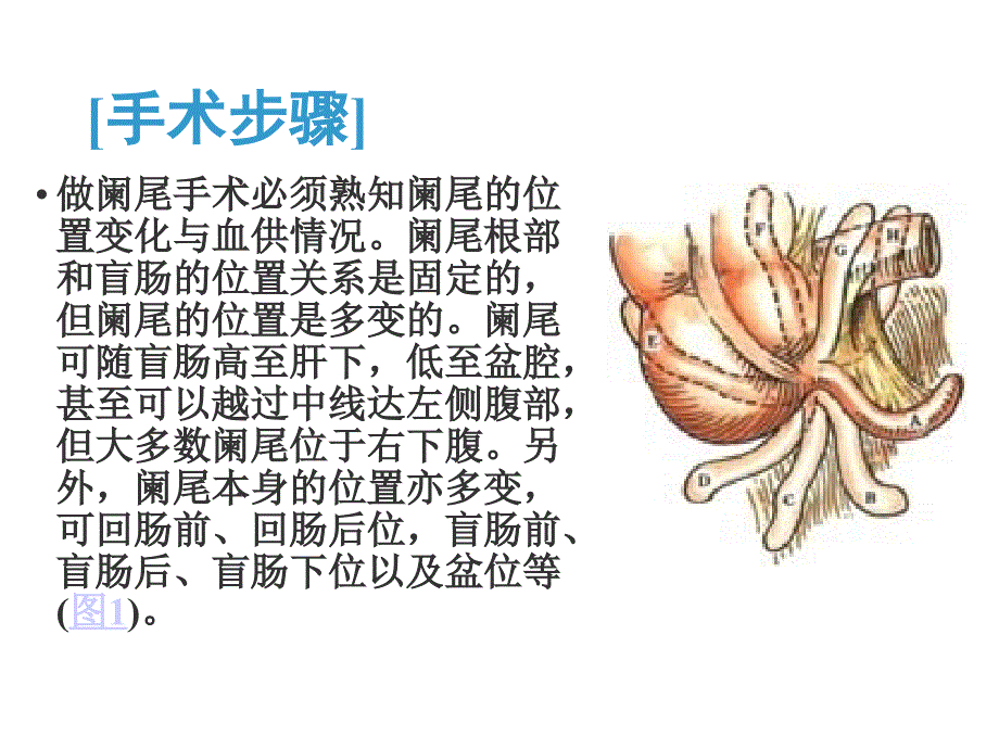 阑尾切除术图解_第4页