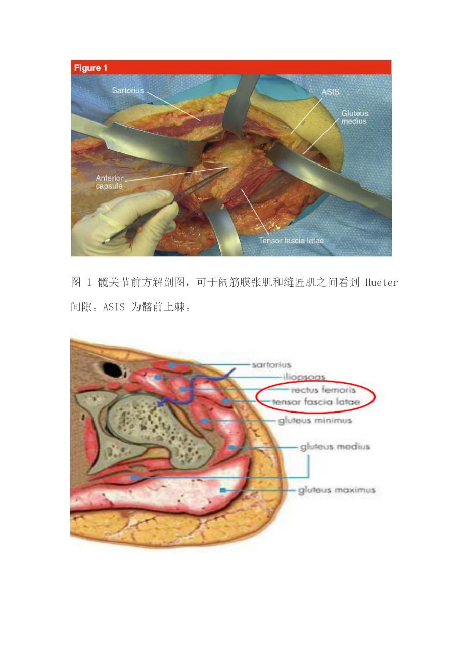 髋关节直接前入路_第3页