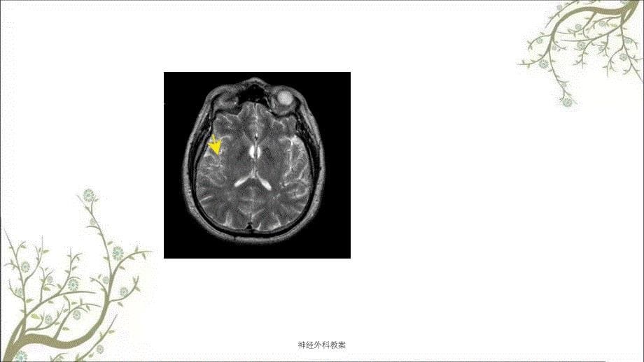 神经外科教案课件_第5页