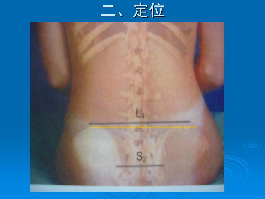 腰硬联合麻醉专家共识_第3页