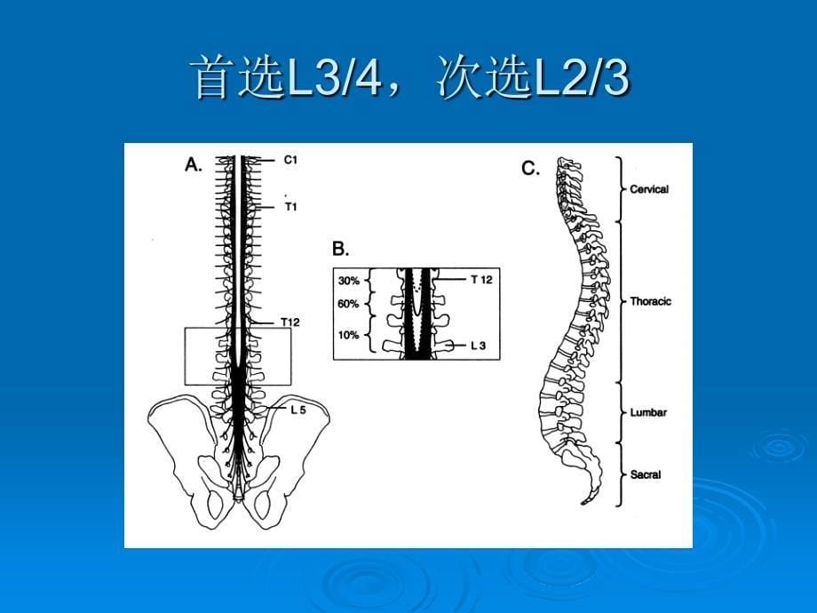 腰硬联合麻醉专家共识_第5页