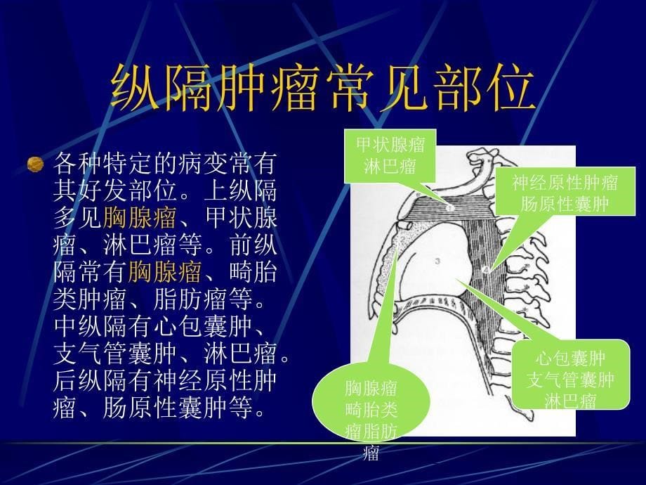 三病区纵膈肿瘤查房_第5页