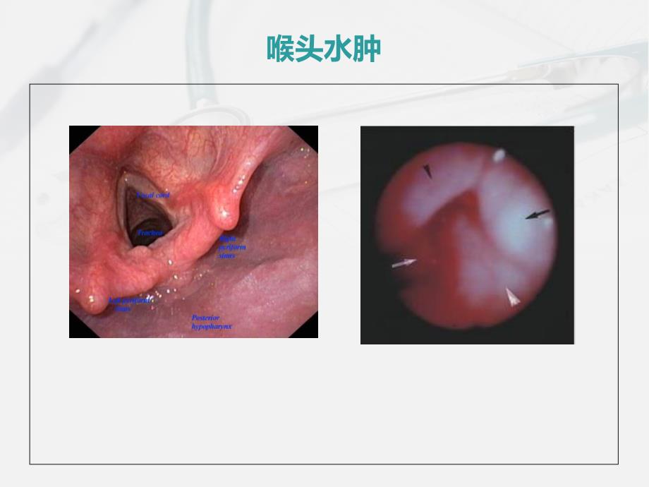 《肺部的病理生理》PPT课件_第3页