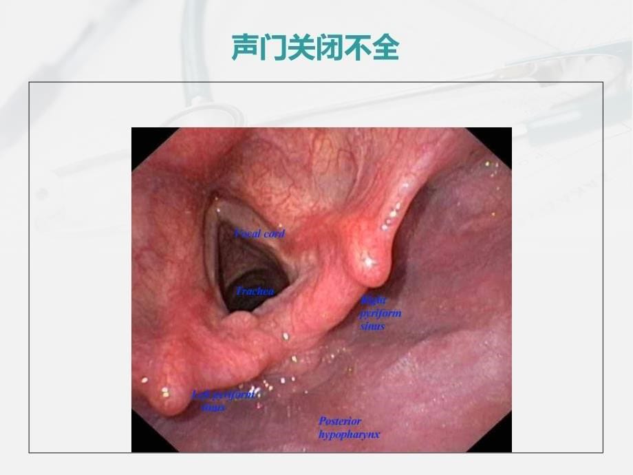 《肺部的病理生理》PPT课件_第5页