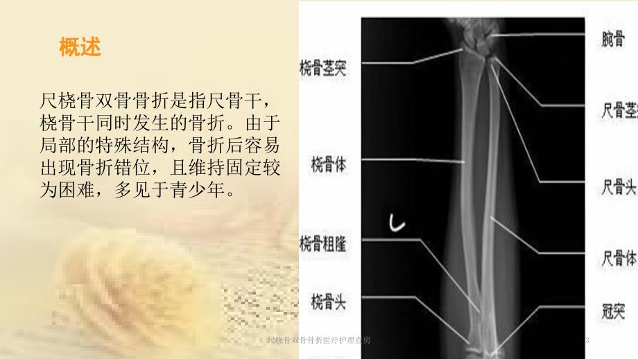 尺桡骨双骨骨折医疗护理查房培训课件_第3页