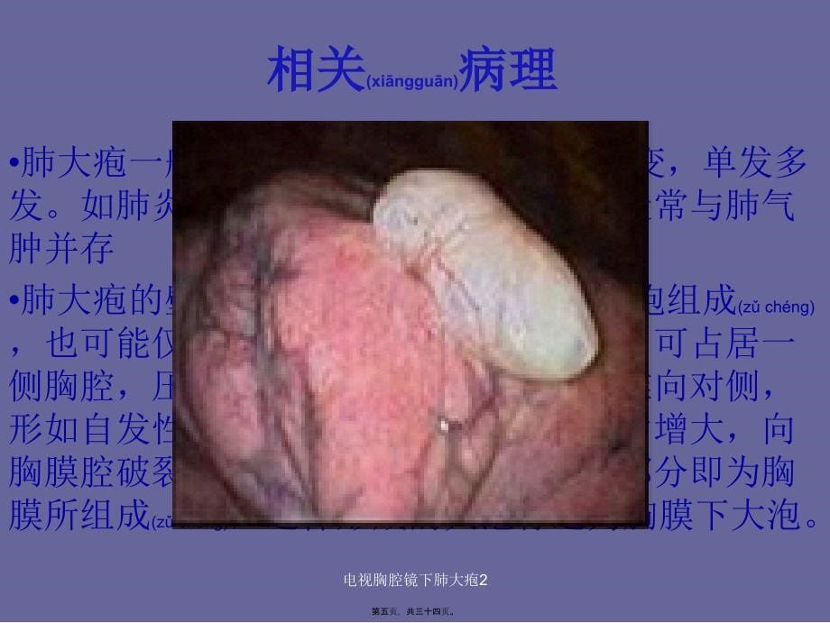 电视胸腔镜下肺大疱2课件_第5页