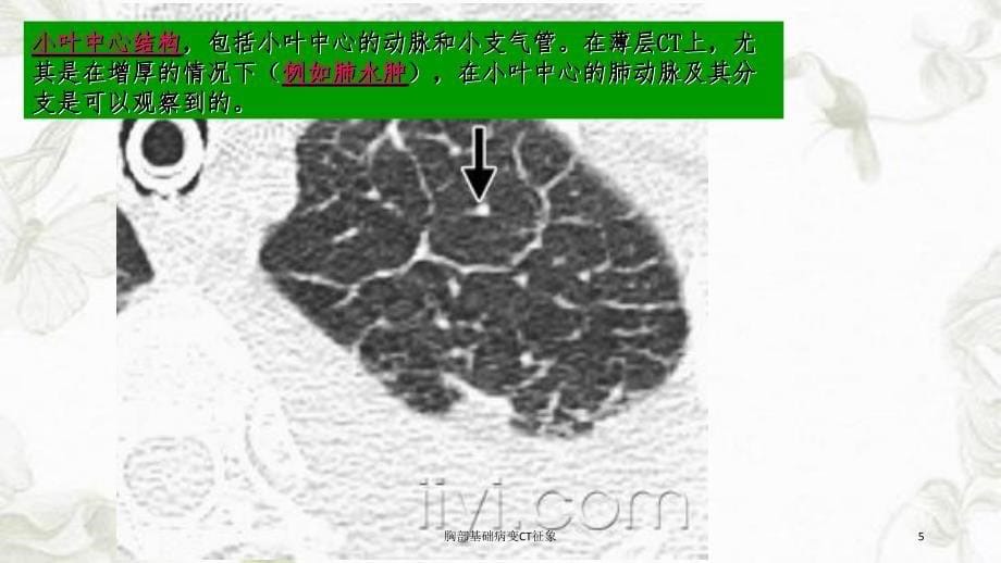 胸部基础病变CT征象课件_第5页