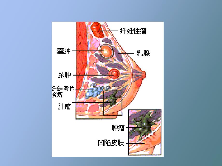 乳癌病人的护理知识_第4页