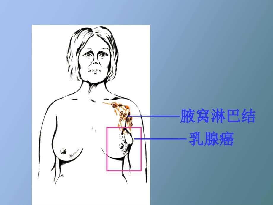 乳癌病人的护理知识_第5页