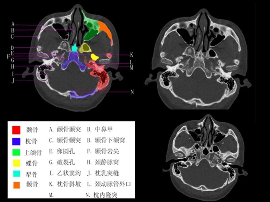 CT影像教学片实验课件_第5页