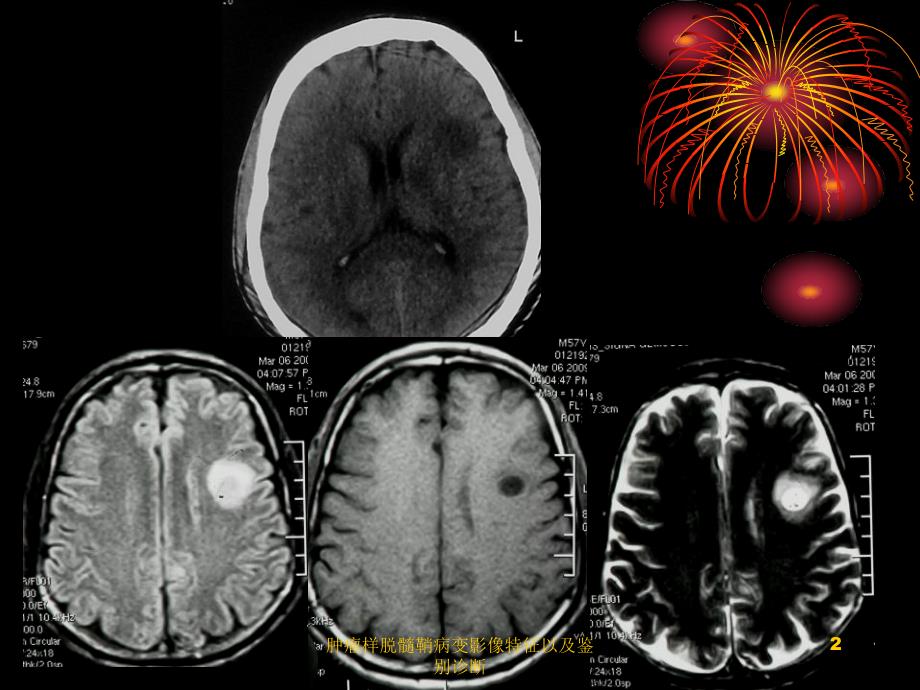 肿瘤样脱髓鞘病变影像特征以及鉴别诊断课件_第2页
