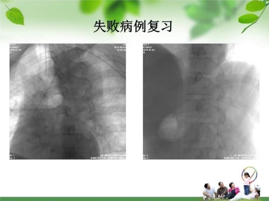 最新双轨道技术处理主动脉夹层术中建立轨道困难教学课件PPT课件_第5页