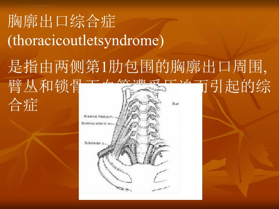 胸廓出口综合症ppt课件_第2页