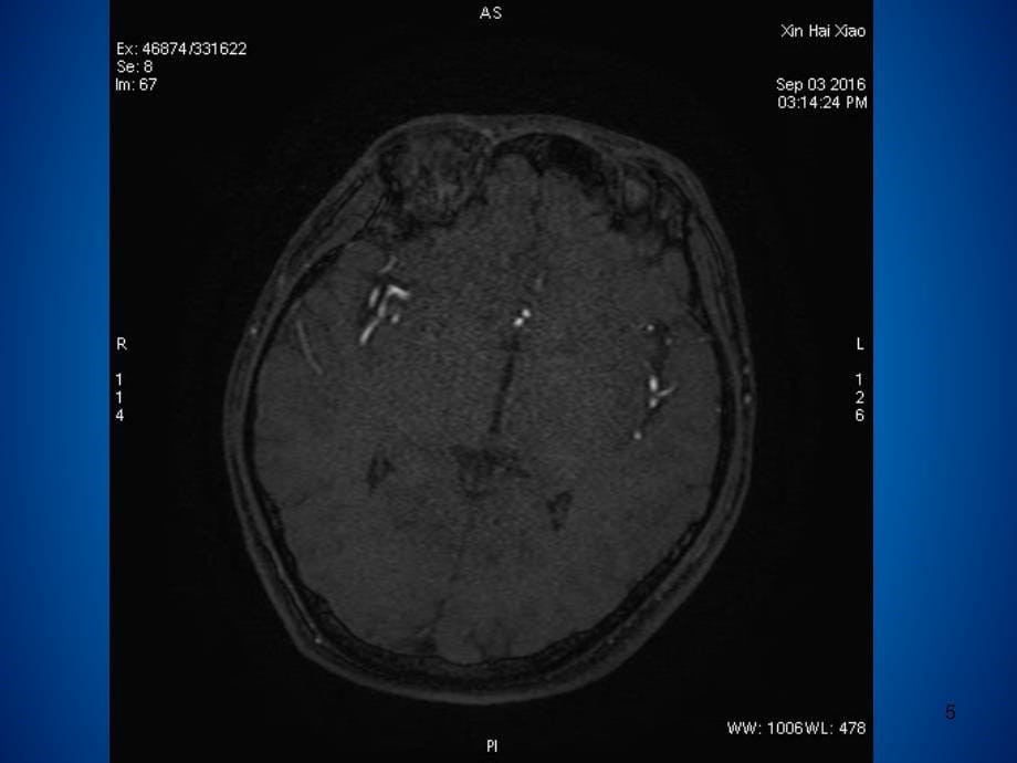 颈动脉夹层病例分析ppt课件1_第5页