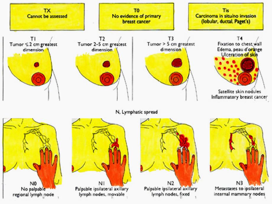 乳腺癌临床病理分期_第3页