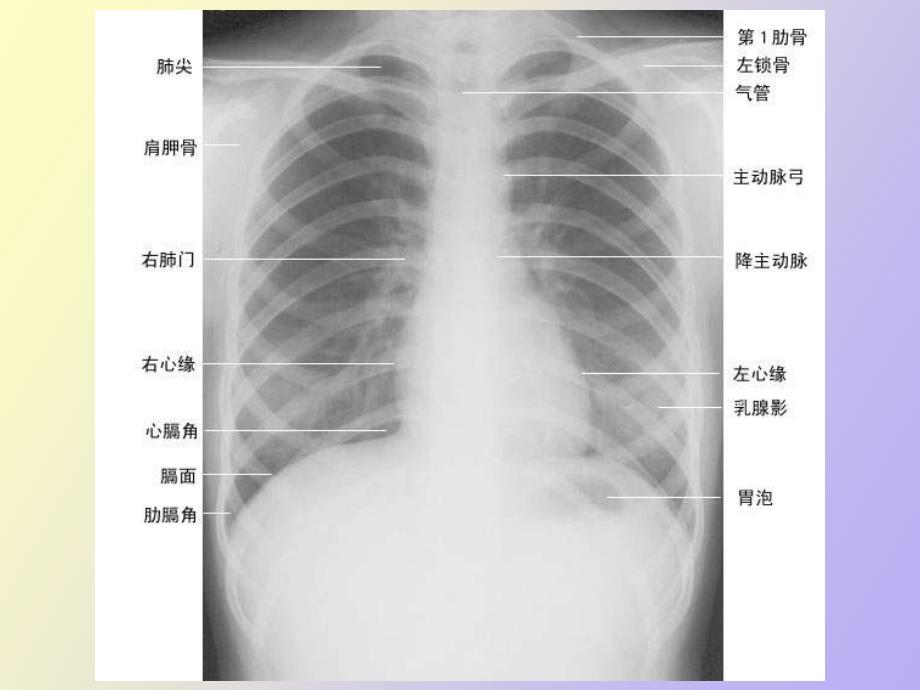 正常胸片胸部CT阅读_第4页