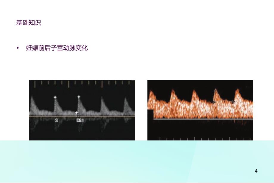 子宫动脉超声监测ppt课件_第4页