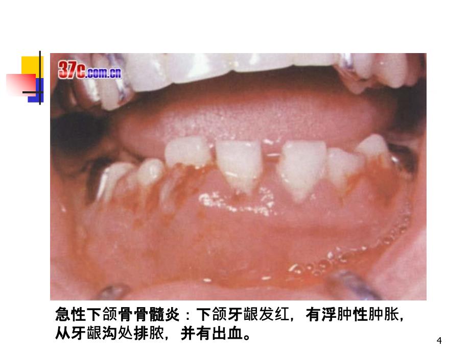 口病十四颌骨疾病PPT课件_第4页