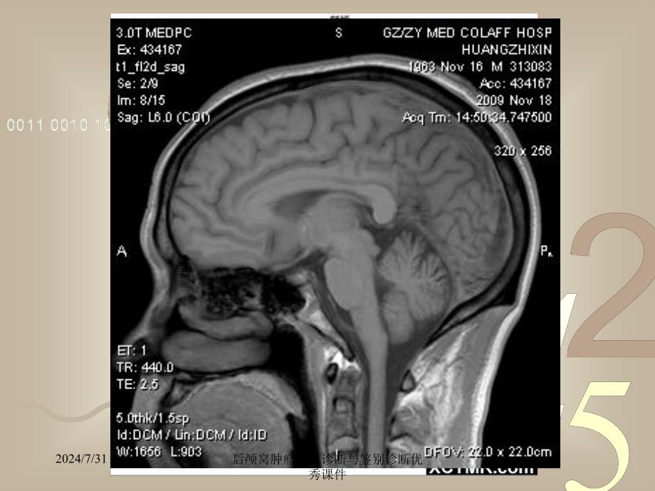 后颅窝肿瘤影像诊断与鉴别诊断优秀课件_第3页
