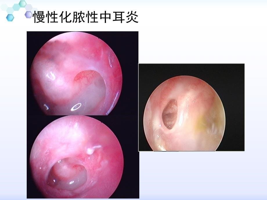 耳鼻咽喉-头颈外科学：3-第六节慢性化脓性中耳炎_第5页